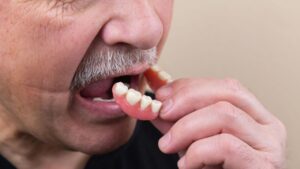 Full Dentures 